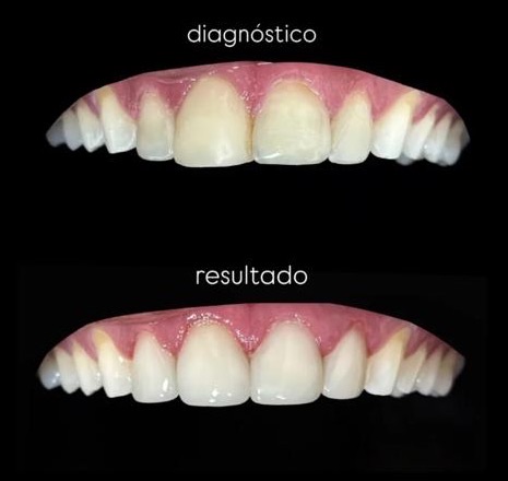 Antes e depois de clareamento dental, paciente da Brivva