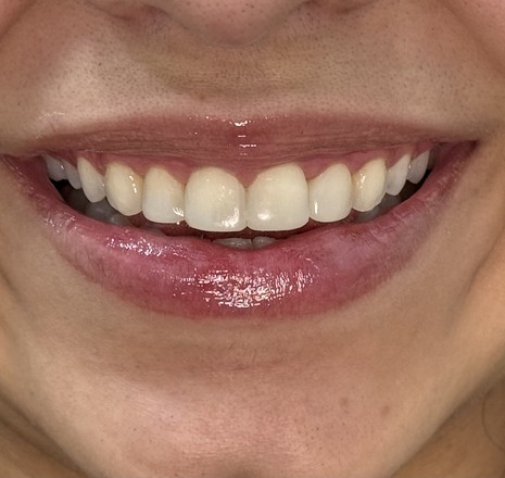 Sorriso de paciente atendida na Brivva Odontologia